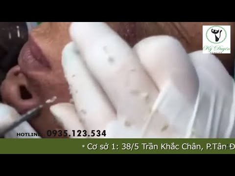 Video Điều trị Mụn ẩn cực kỳ ghê gớm do uống thuốc đau dạ... - youtube