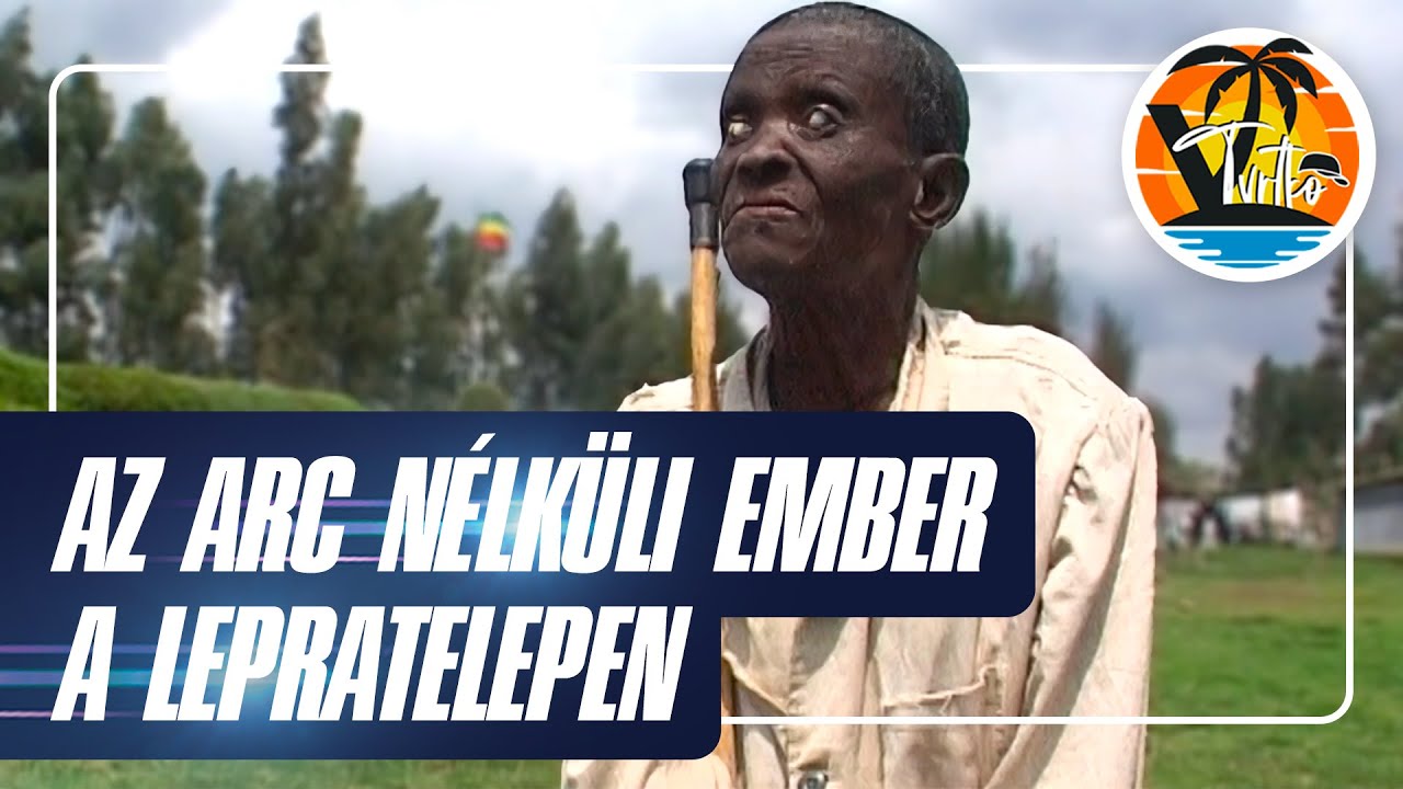 Arc nélküli emberek: a lepratelep titkai!