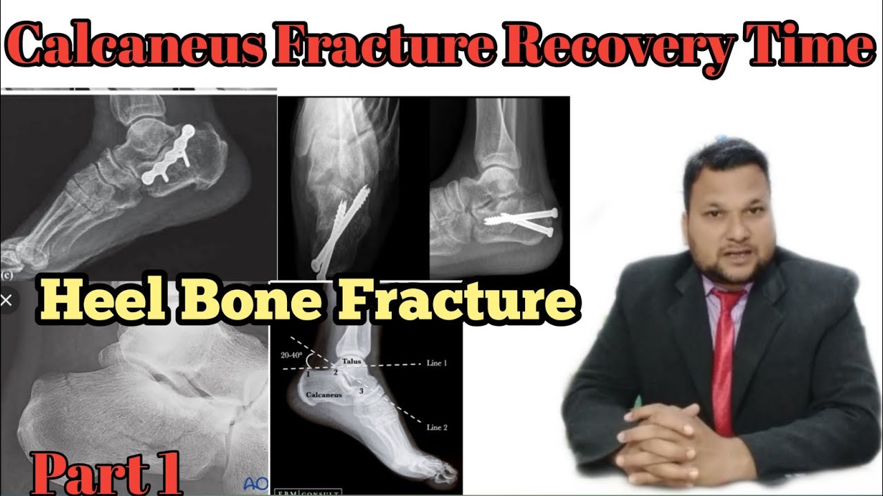 Calcaneal Stress Fracture: [Causes, Symptoms &BEST Treatment!]