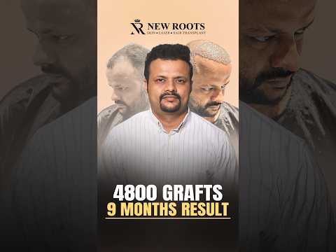 4800 Grafts Hair Transplant Results | Best in Mumbai #hair #shorts #ytshorts