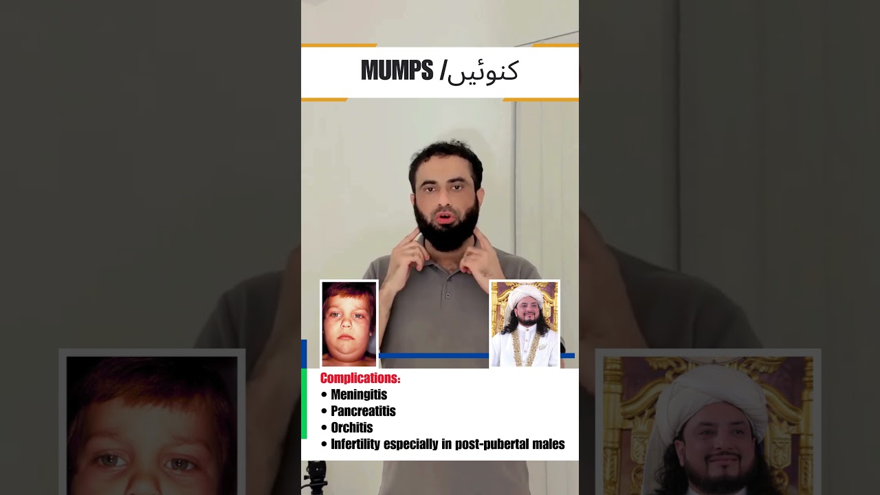 Mumps / کنوئیں | Exam Key Points | Dr Hafiz Atif | First Aid Made Easy Platform #FCPS #NRE #USMLE