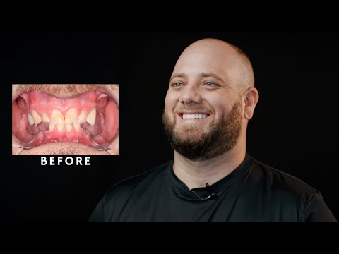 Teeth By Tonight Procedure! All On Four Dental Implants / Houston Dentist