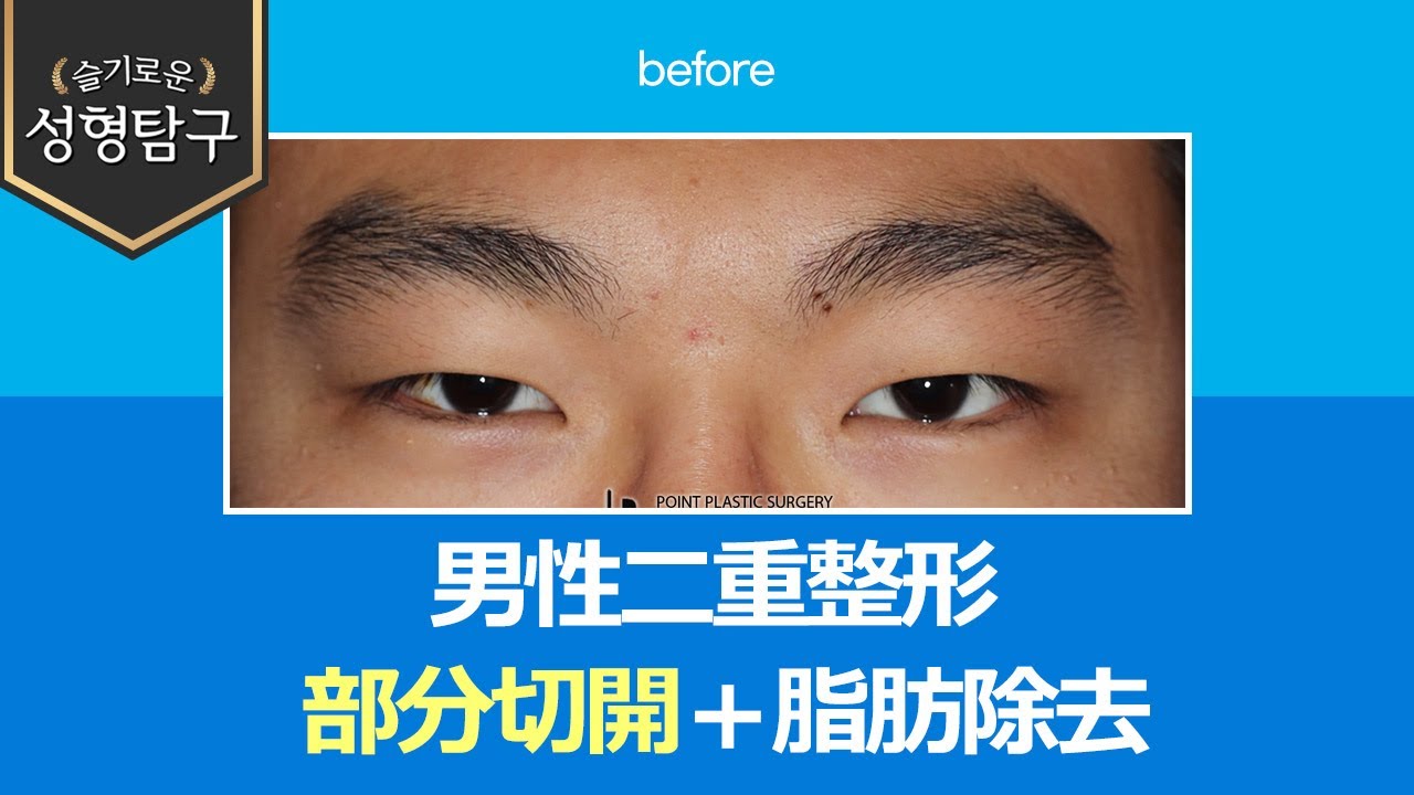 【韓国二重整形】男性の二重整形、部分切開法と脂肪除去