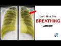 Chest X-ray ABCDE (Including F): Most Students Miss This (Breathing)