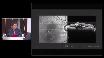 Multimodal Imaging of PCV (Aneurysmal Type 1 NV)