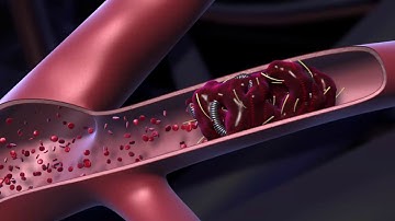 Coil Embolization Video