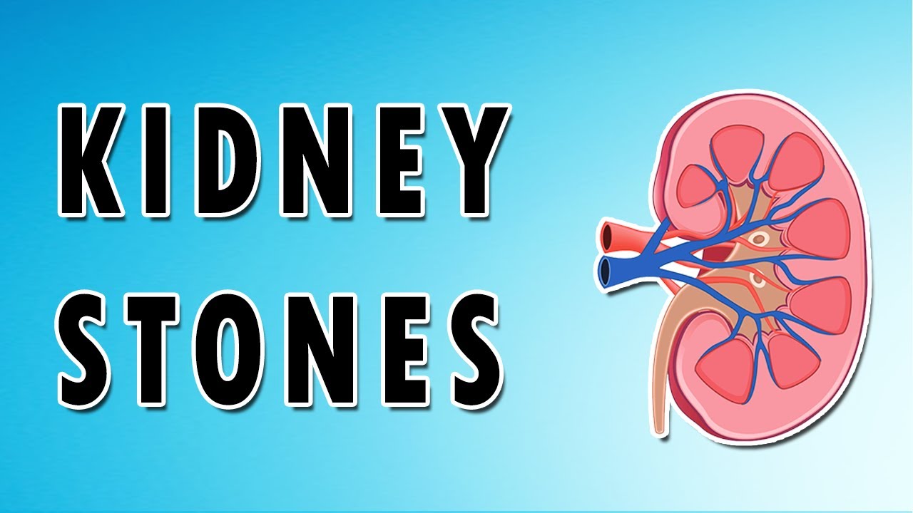 What Causes Kidney Stones - Calcium Oxalate, Struvite And Cystine Stones