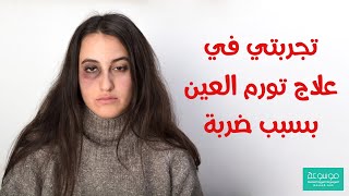 ما علاج الزراق تحت العين المضروبة