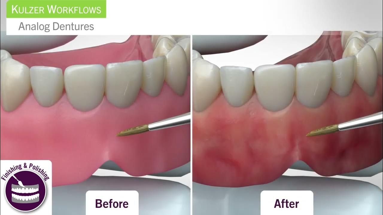 Analog Denture Workflow Step 5 Finishing and Polishing YouTube