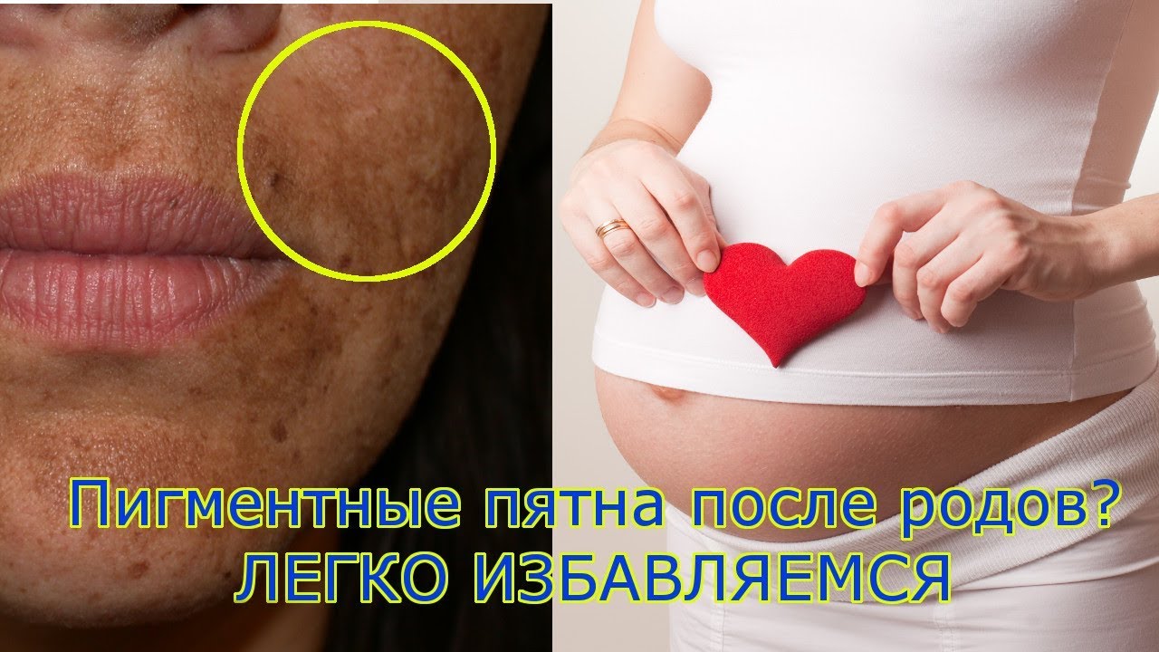 ЭТО видео 100% ПОМОЖЕТ избавиться от ПЯТЕН на лице?