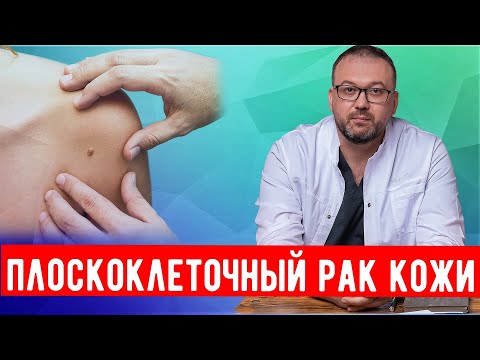 Плоскоклеточный рак кожи, что это и как лечить.