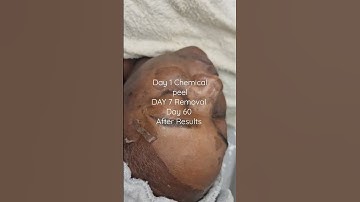 Thumbnail of EB Chemical peel for Pigmentation,  Spots, Scarring