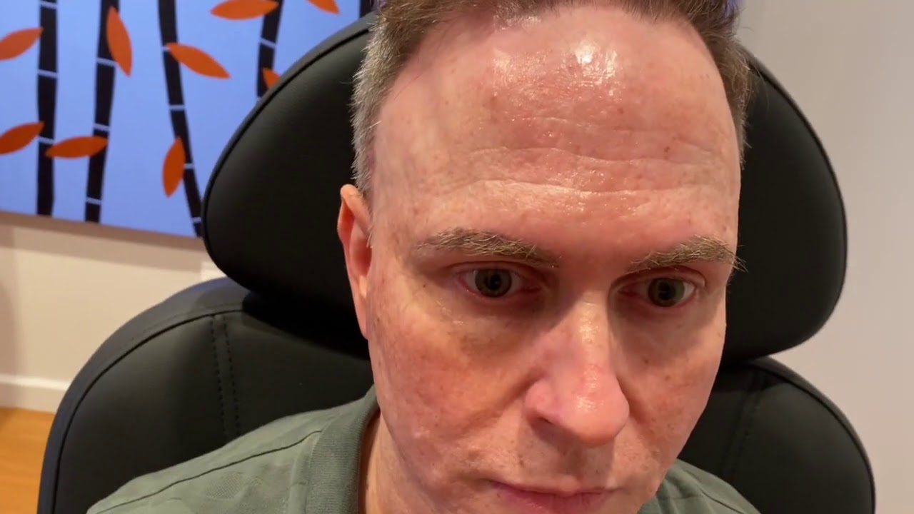 Dallas Hair Transplant Surgeon Dr. Sam Lam Talks about Fibrosing Alopecia or FFA