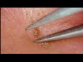 0321 keratin plug removal nose