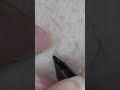081 Perfect buried hair #tweezers #毛抜き#shorts
