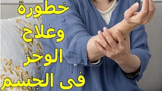 أسباب الوخز بالجسم | مضاعفات هذه المشكلة | معلومات هامه جداً