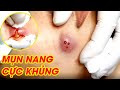 Mụn khổng lồ | Kỹ thuật lấy mụn độc quyền cam kết không thâm sẹo | HHV Clinic | Đỗ Thu Hiền