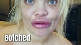 youtubers who got BOTCHED lip fillers