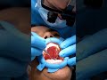 How Dentists Replace Missing Teeth | Bone Graft and Dental Implant Explained #shorts