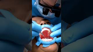 How Dentists Replace Missing Teeth | Bone Graft and Dental Implant Explained #shorts