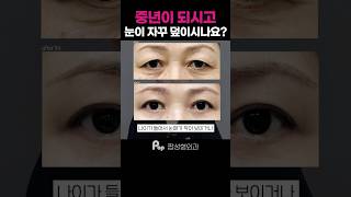 #상안검수술 #눈꺼풀처짐 🤨아직도 고통을 느끼시나요⁉️