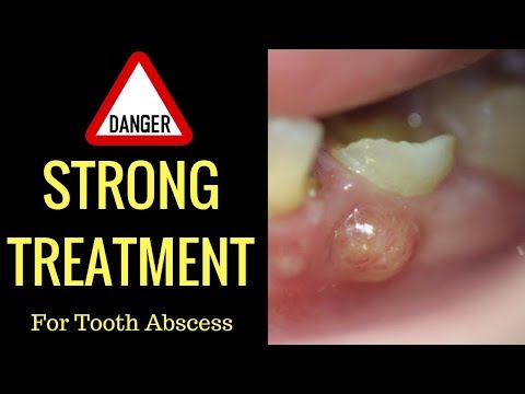 Cure Tooth Abscess Naturally In Record Time With This 1 Basic Technique