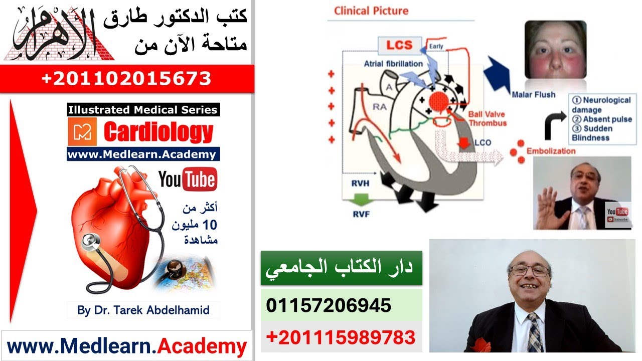 Mitral Stenosis   #cme #internal_medicine #usmle #medical #ecg #محاضرات_باطنة
