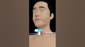 how is tracheostomy done? #medicalanimations #medicalfacts #hindishorts #3danimation