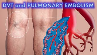 DVT and Pulmonary Embolism (Updated 2022)  CRASH! Medical Review Series