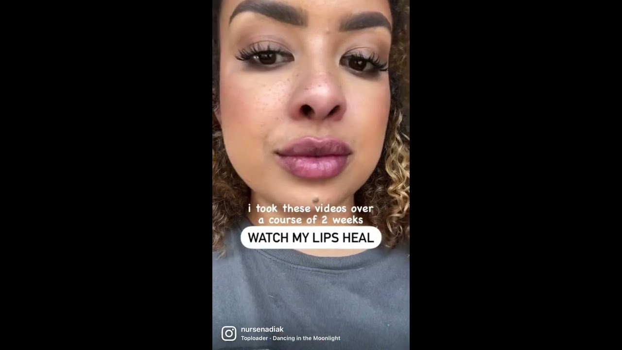 Lip Filler Healing Process
