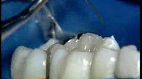 CeramX duo restauración Clase II Dr P.Colon /2