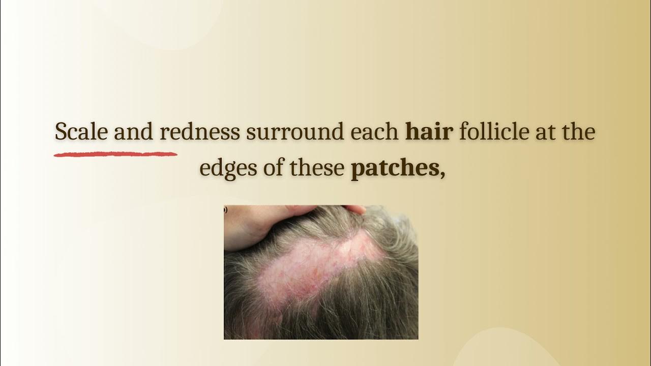 Clinical features of Lichen Planopilaris Best Dermatology Centres in