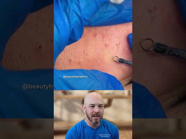 Chin Blackhead Extractions #skincare #blackhead