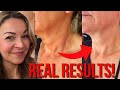 DIY ‘turkey neck’ fix | Aesthetician reveals dramatic lift with this massage method!