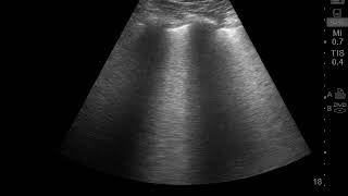 Covid-19 Lung With Confluent B Lines