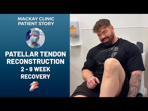 Patellar Tendon Rupture Recovery Timeline – Internal Brace vs Traditional Surgery