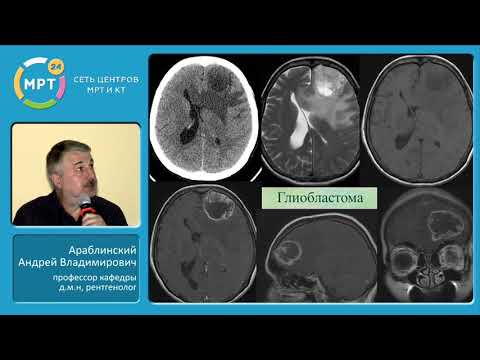 Видео: Мозъчен тумор (астроцитом) при кучета