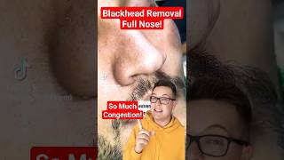 BLACKHEAD REMOVAL On Nose - New Technique shorts