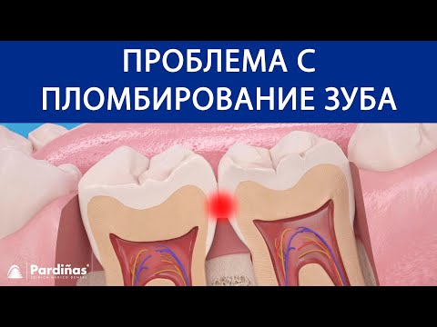 Проблема С Пломбирование Зуба Переполняться Зубная Пломба ©