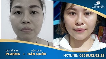 Nâng mũi hàn quốc + cắt mí mắt + độn cằm đẹp tự nhiên