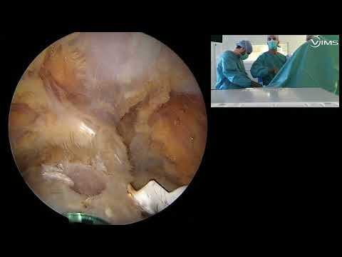 ARTHROSCOPIC LATARJET WITH SCREWS: TECHNIQUE, TIPS AND TRICKS