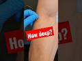 IS dry needling right for YOUR pain? (elbow pain) #shorts #health