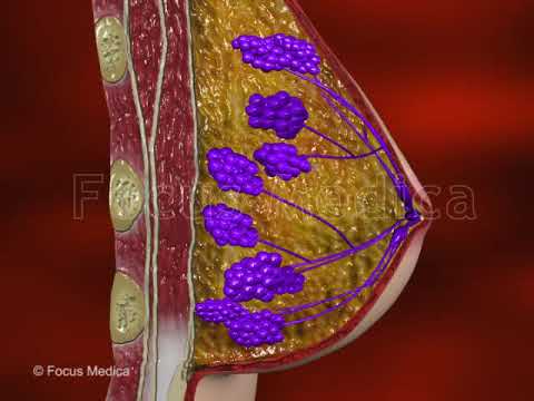 Video: Tubular Carcinoma: Orsaker, överlevnadshastigheter Och återfall