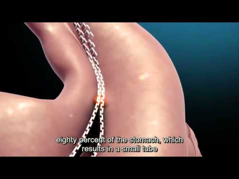 Video: Adakah sesiapa yang meninggal dunia akibat pembedahan pintasan gastrik?