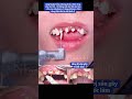 đặt chốt + bọc sứ - cho răng bị sâu hỏng #nhakhoacodofa  #dentist  #veneers