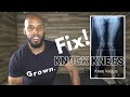 Fix Knock Knees (Knee Valgus)