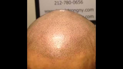 3d Scalpmicropigmentation - Natural, Slow and broken w/Chris