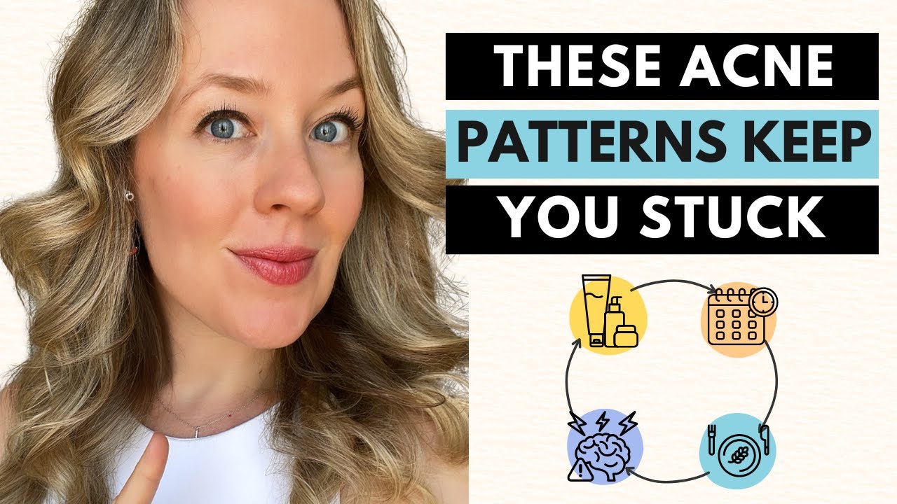 Почему у меня до сих пор появляются высыпания? — 5 скрытых типов угревой сыпи, которые мешают вам...