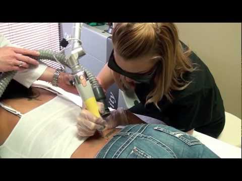 Tattoo Removal Houston TX Houston Tattoo Removal Clinic ...