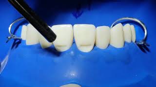 Class V tooth colored restorations